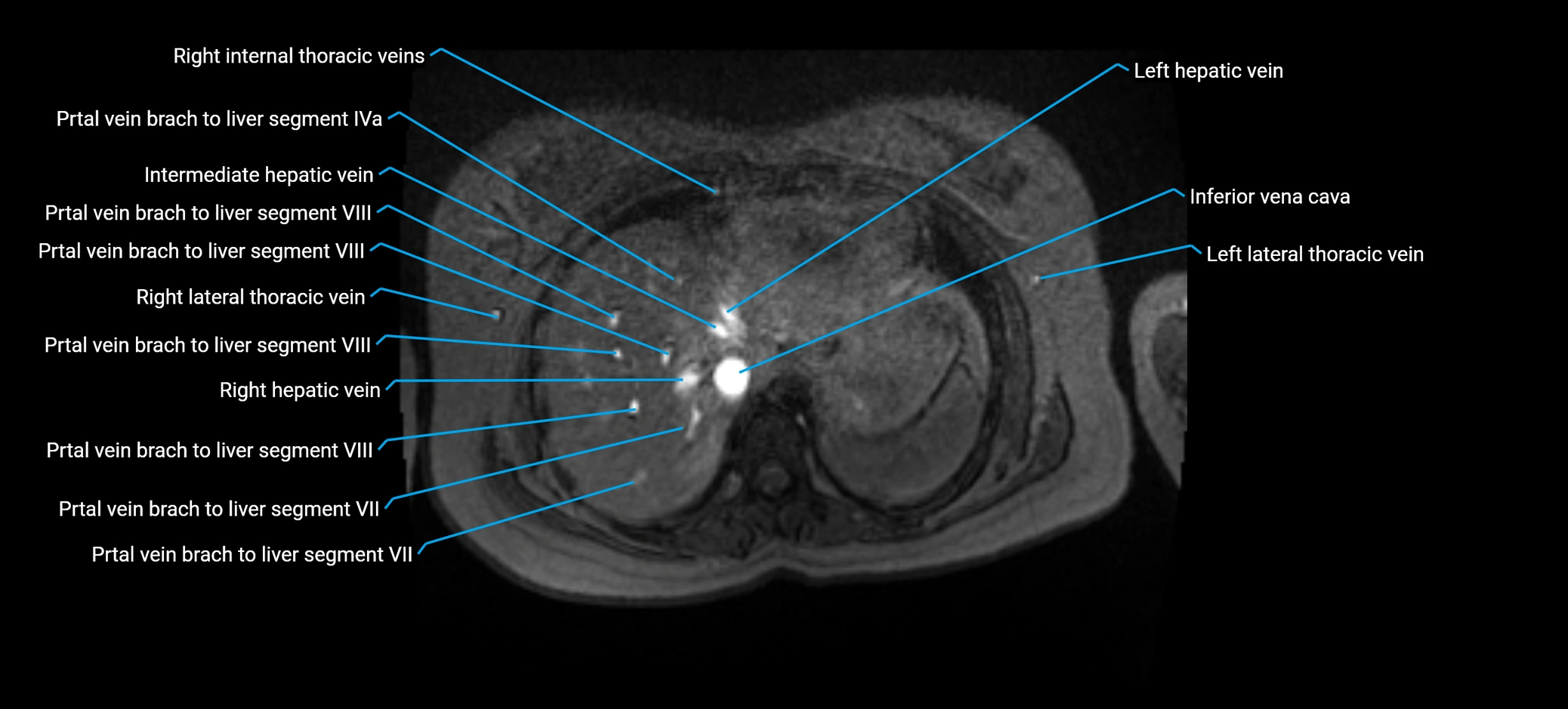 MRV abdomen pelvis & lower limb axial cross sectional anatomy labelled MRI image 20 (1).webp